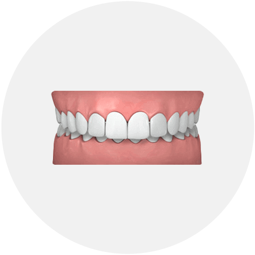 common-cases-overjet