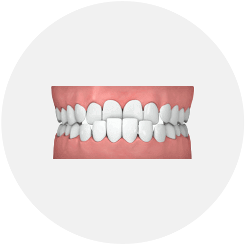 common-cases-underbite