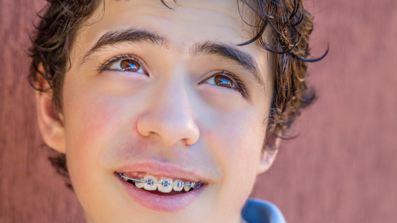 A Guide To Getting Braces Just On Your Bottom Or Top Teeth Richard Chan Orthodontics