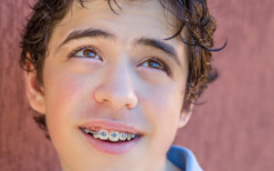 A Guide to Getting Braces Just on Your Bottom or Top Teeth | Orthodontist