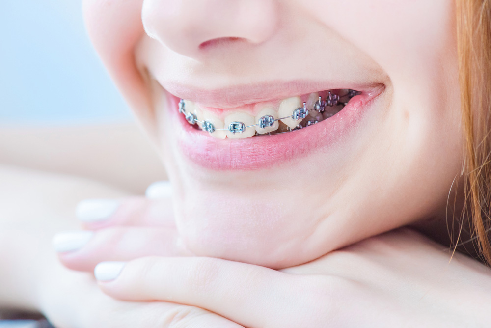 Myths and Facts About Orthodontics