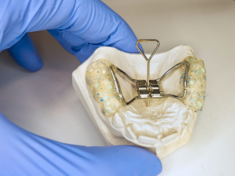 Spf Expander Everything Parents Should Know About Rapid Palatal Expanders